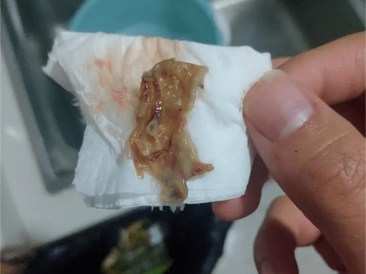 造成组织细胞异常脱落,与病原菌以及病原菌代谢物混杂在鼻腔黏膜的