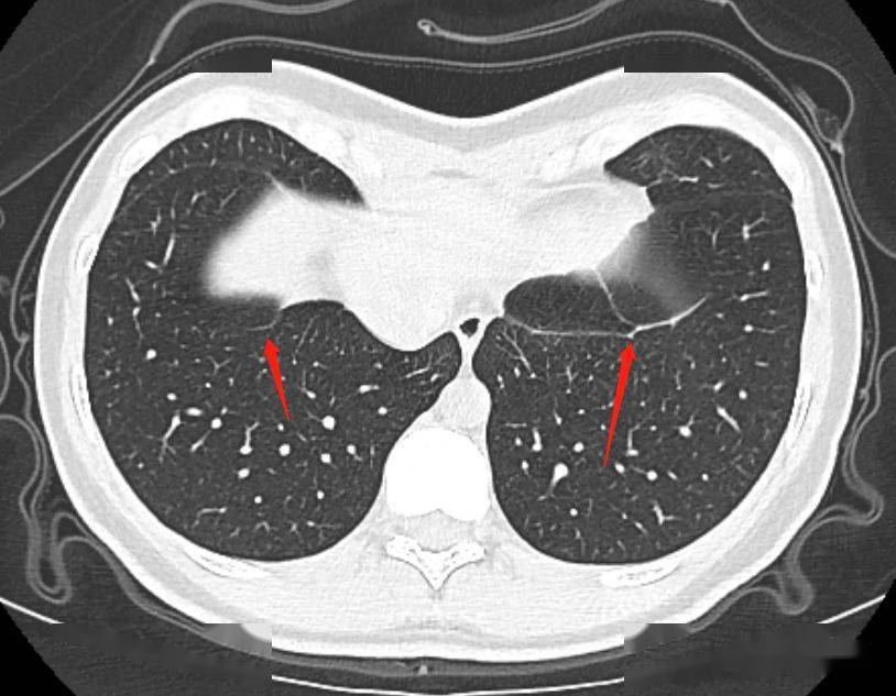 胸部ct上的"肺韧带",别再报纤维条索了_影像_纵隔_解剖图