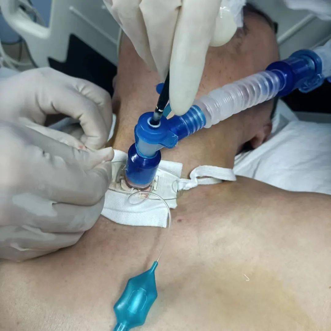 纤支镜引导下的经皮穿刺气管切开术是一项新的微创技术,是呼吸系统的