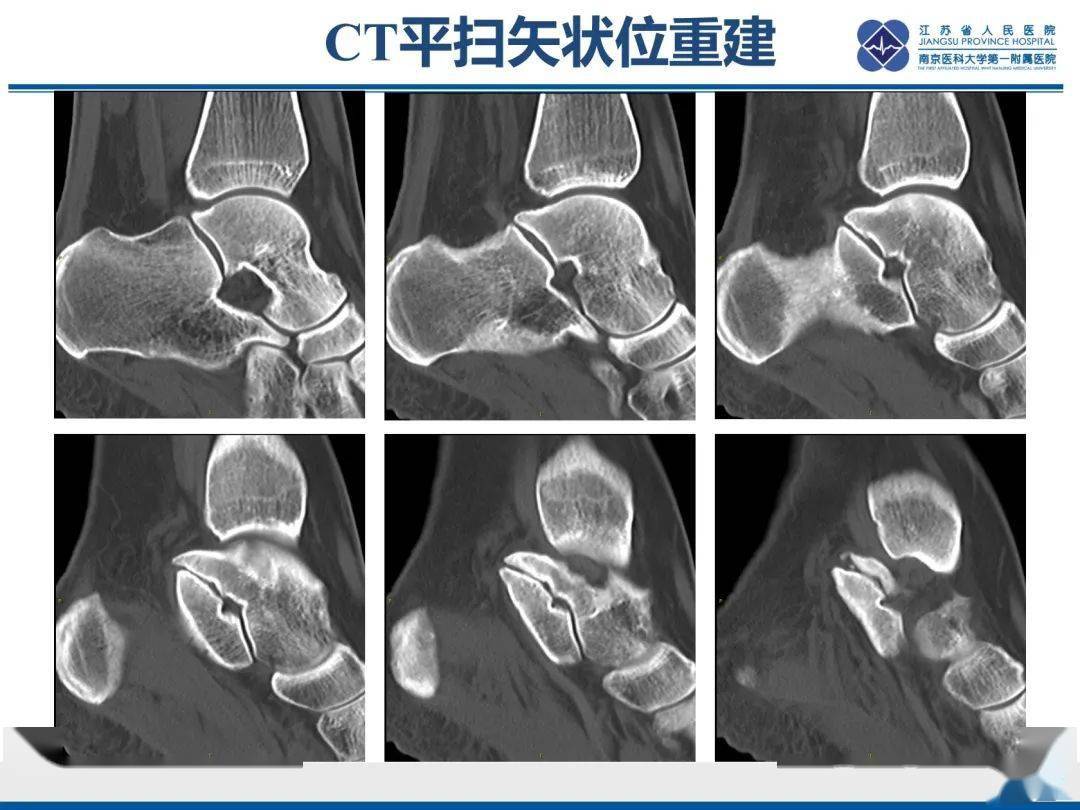 跟骨距骨桥分型及影像表现