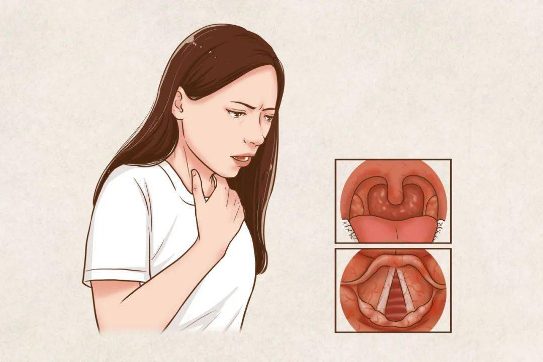 反流性咽喉炎,是指胃内容物反流至食管上括约肌以上的咽喉部,反流物