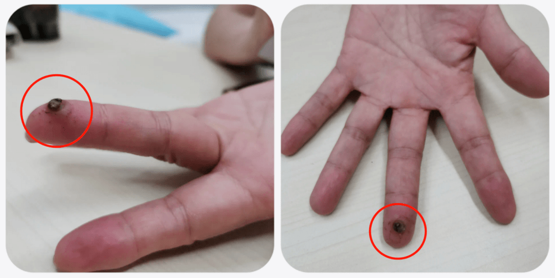 手指冒出小红点,结果长成"一碰就出血"的大包?_治疗_姐姐_手术