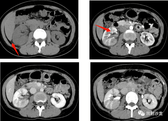 病例1:女,31岁,右侧腰部疼痛并发热3天,急性肾盂肾炎.脓肿形成.