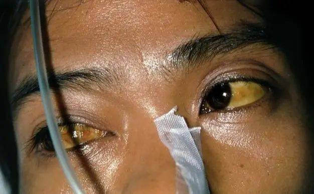 肝癌患者临死前会经历哪些痛苦?患上肝癌一般能活多久?