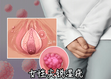 人乳瘤病毒女性症状图片