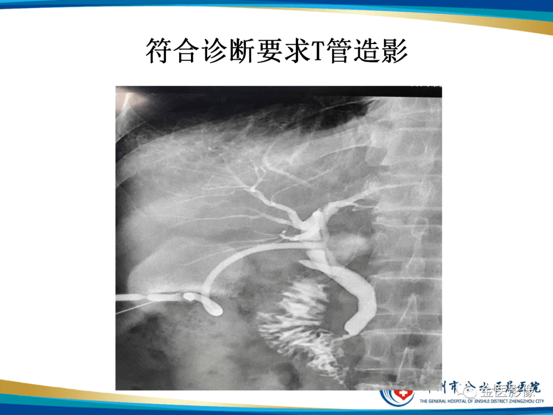 造影检查技术篇之t管造影