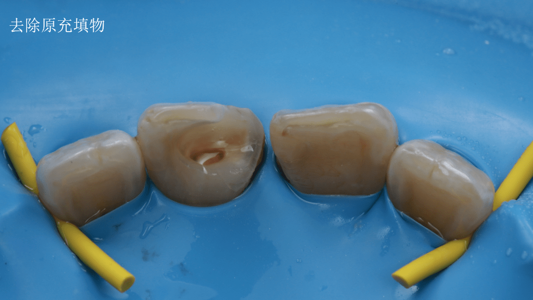全国决赛12强病例展示 石峰 上前牙树脂仿生修复一例