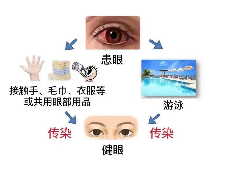 红眼病图片 传染途径图片