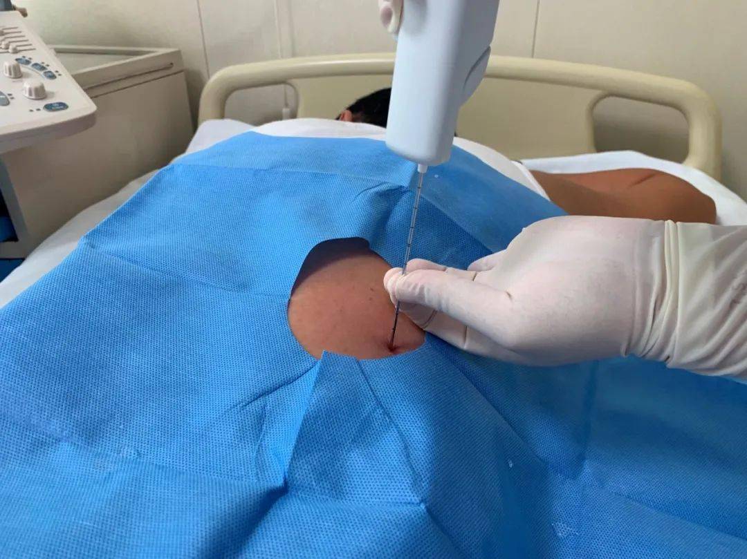 了解"肾穿刺",让你不再谈"穿"色变