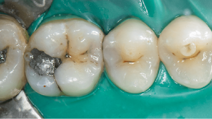 全国决赛12强病例展示 廖俊 上颌后牙ii类洞纳美树脂充填一例