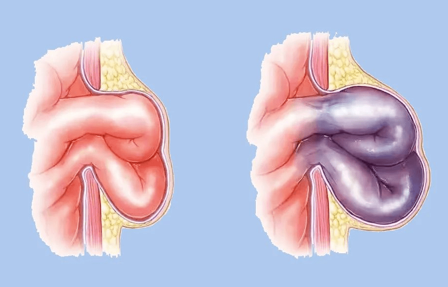七旬老人闭孔疝并肠梗阻