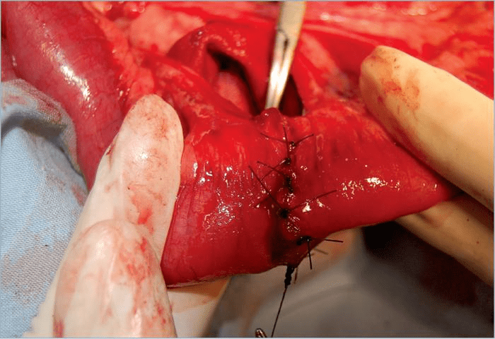 外科实用技术图谱19张图片视频详解肠切除术