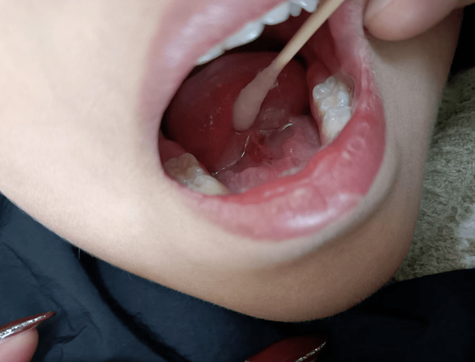 舌系带短,剪还是不剪呢?_手术室_舌头_影响