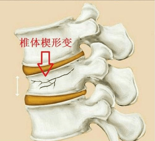 椎体楔形变图片