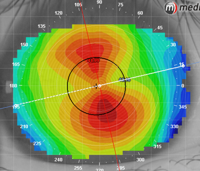 角膜地形图报告单解析图片