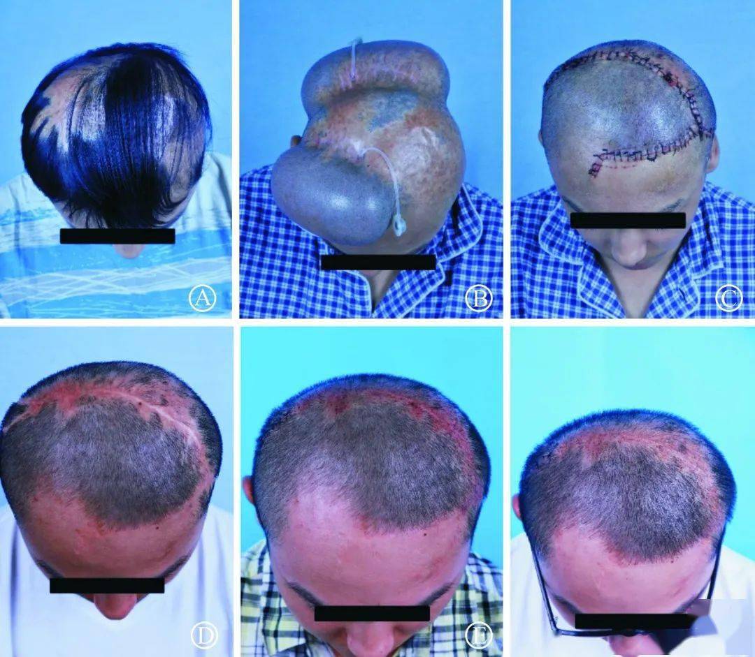 为了去掉一个「痣」,医生给她头皮灌入 4 个大水球_扩张_蒋敏_手术