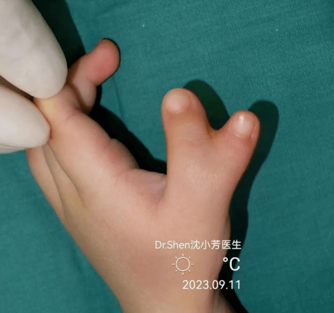 医生,我想把女儿的手指移植到脚上