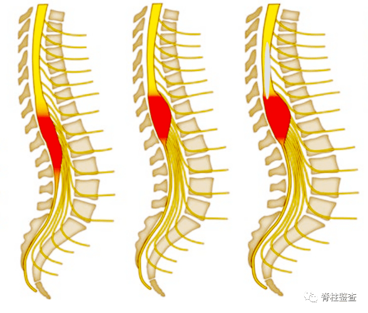 椎管内粘液乳头状室管膜瘤几乎全部起源于脊髓圆锥及终丝,占该区域室