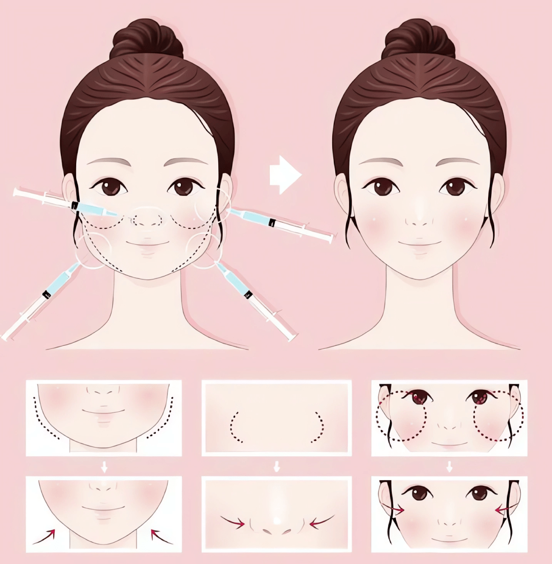 与美同行⑦丨"美"有道理 ,肉毒毒素瘦脸提升篇_美容_面部_整形