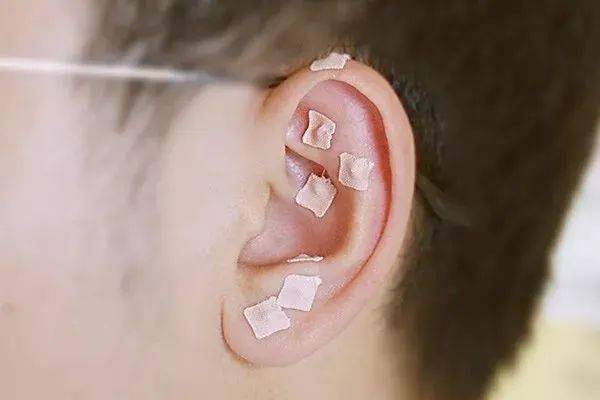 【招募】防治青少年近视,耳穴压丸治疗来帮忙