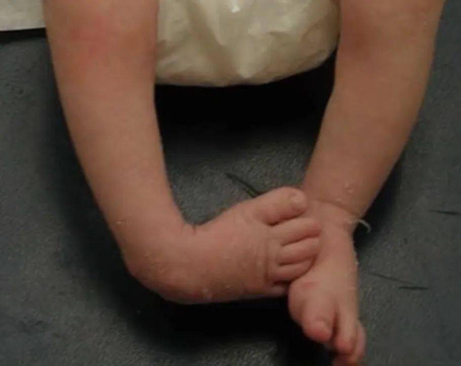 脊柱裂婴儿图片
