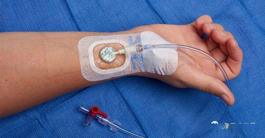 实用技术 | 桡动脉置管的10大技巧_血管_导管_相关