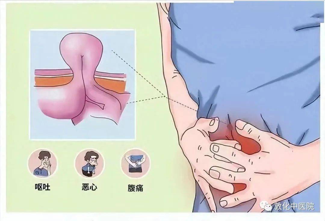 勿以"疝"小而不为|中医院普外科带您了解疝气_肿块_症状_腹部
