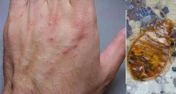 韩国大学寝室商店健身房现大面积虫卵,香港地铁也遭侵袭?