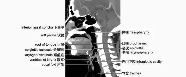 頸部影像解剖(必點收藏)_會厭_層面_頸椎