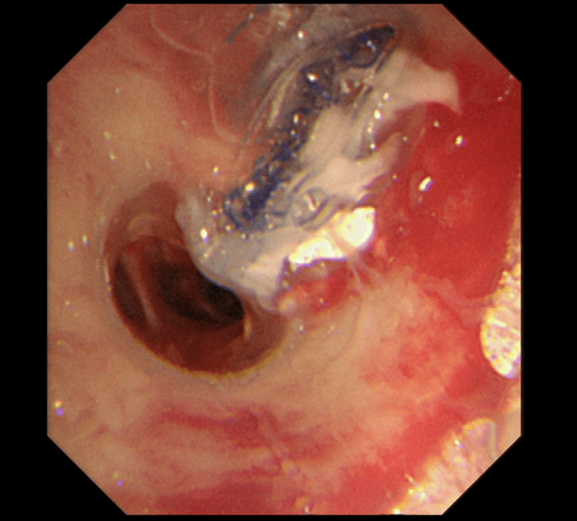 技术前沿丨创新方案治疗难治性气胸_张军_河南省_患者