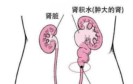 输尿管结石症状图片