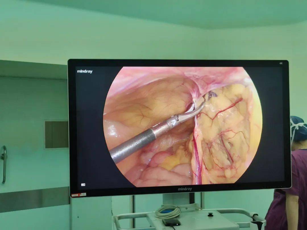 图三 腹腔镜下肠系膜病损切除术▲图二 腹腔镜下直肠癌根治术▲图一