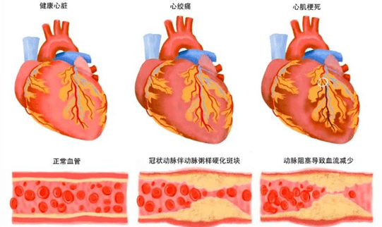 冠心病分类图片图片