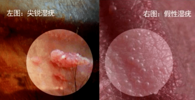 外阴口长了肉疙瘩图片图片