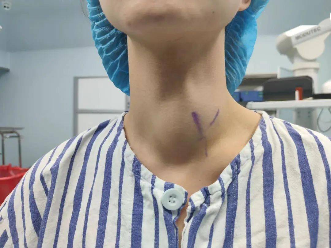 颈椎后结节定位图图片