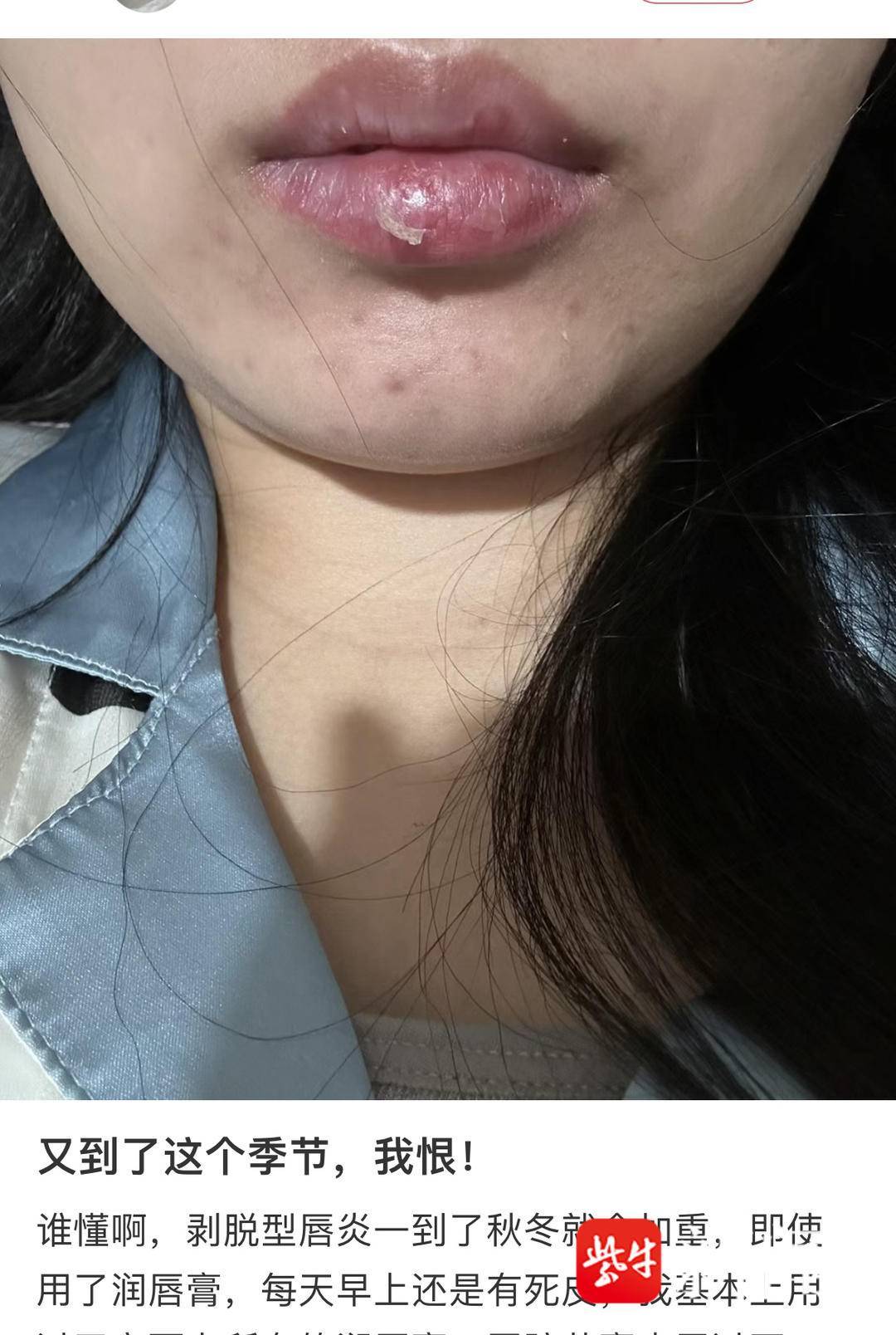 唇膏过敏症状(唇膏过敏会出现什么症状)