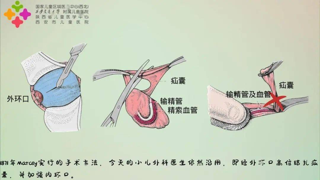 隐睾手术图解图片