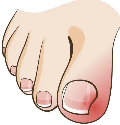 这种"神器"很多女生都有…_趾甲_脚趾_医生