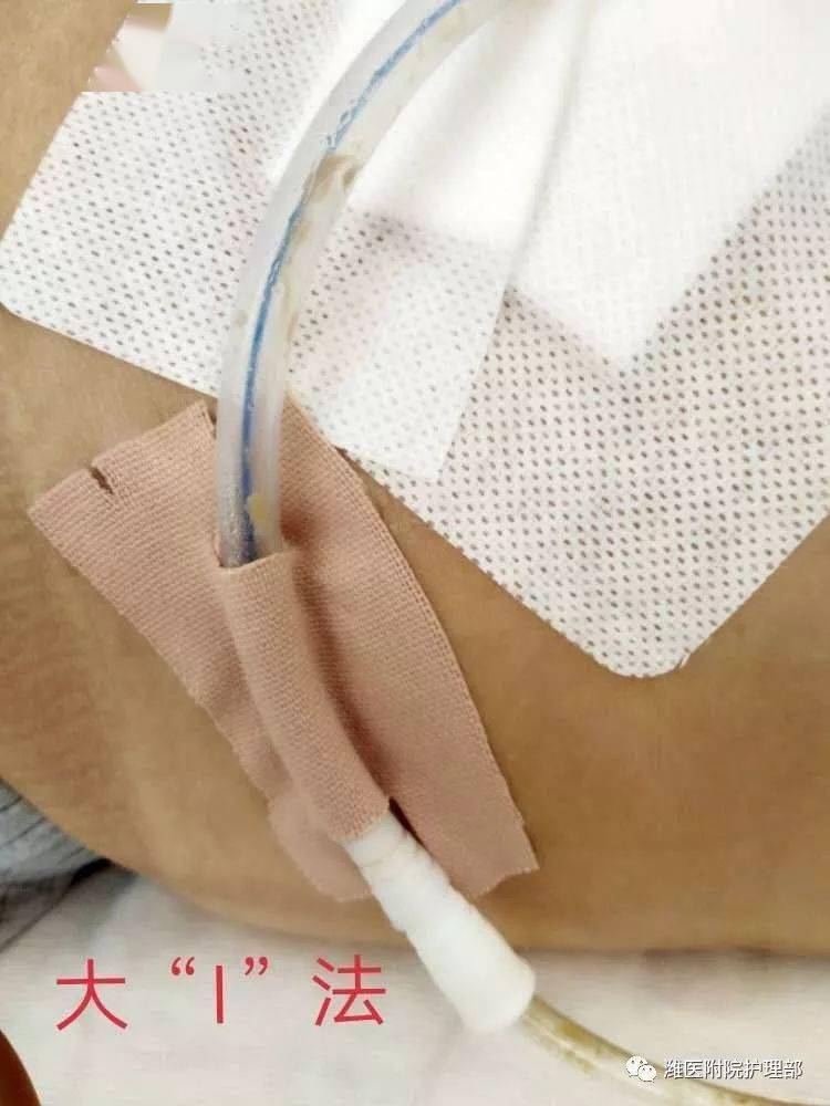 要开始固定引流管啦15床王先生术后返回病房时带了6根管路,分别是胃管