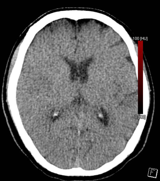 正常,左上肢肌力3级,左下肢肌力4级,右侧肢体肌力5级,左侧巴氏征阳性