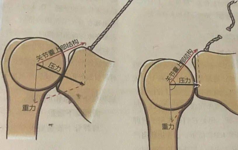 【医文医话】康复中心:脑卒中碰上肩关节半脱位怎么