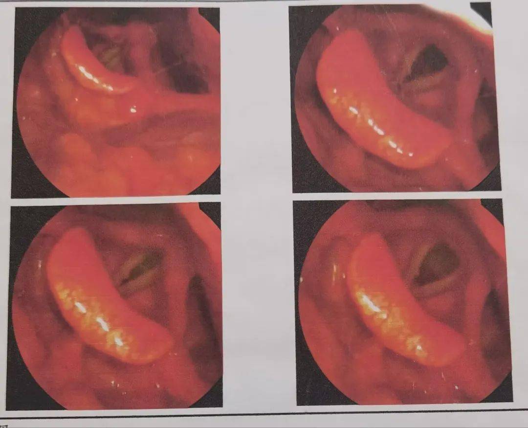三都县中医医院眼耳鼻喉科成功开展首例鼻内镜鼻前庭囊肿揭盖术,首例