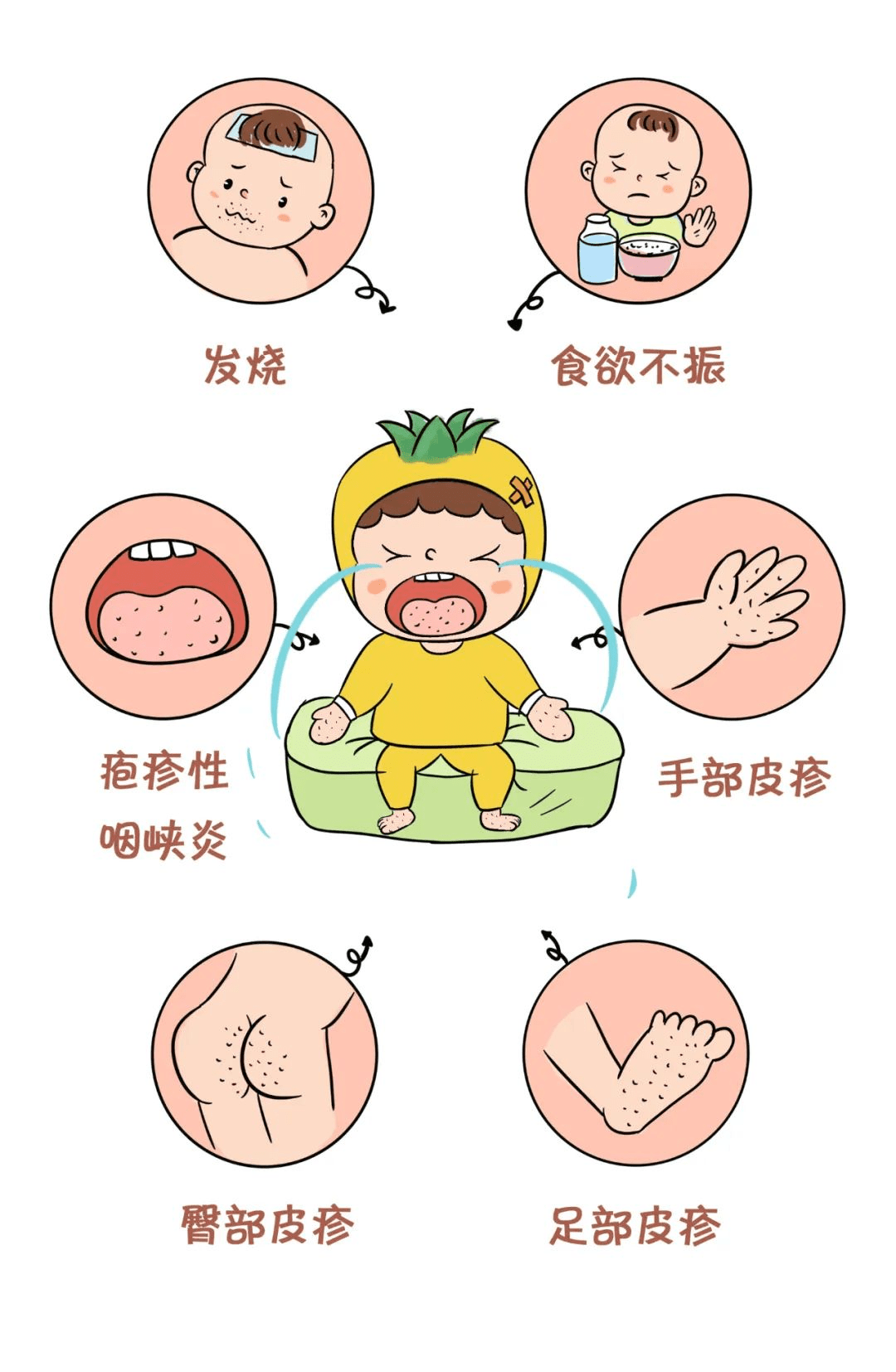 主要症狀潛伏期1-3周沒有任何症狀,發病後會有感染表現,多見於5歲及