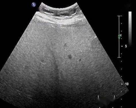 浙江省立同德医院超声医学科的超声检查技术肝脏纤维化和脂肪变性