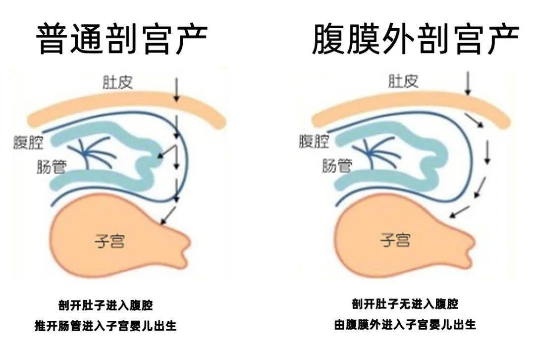 剖宫产手术图解图片