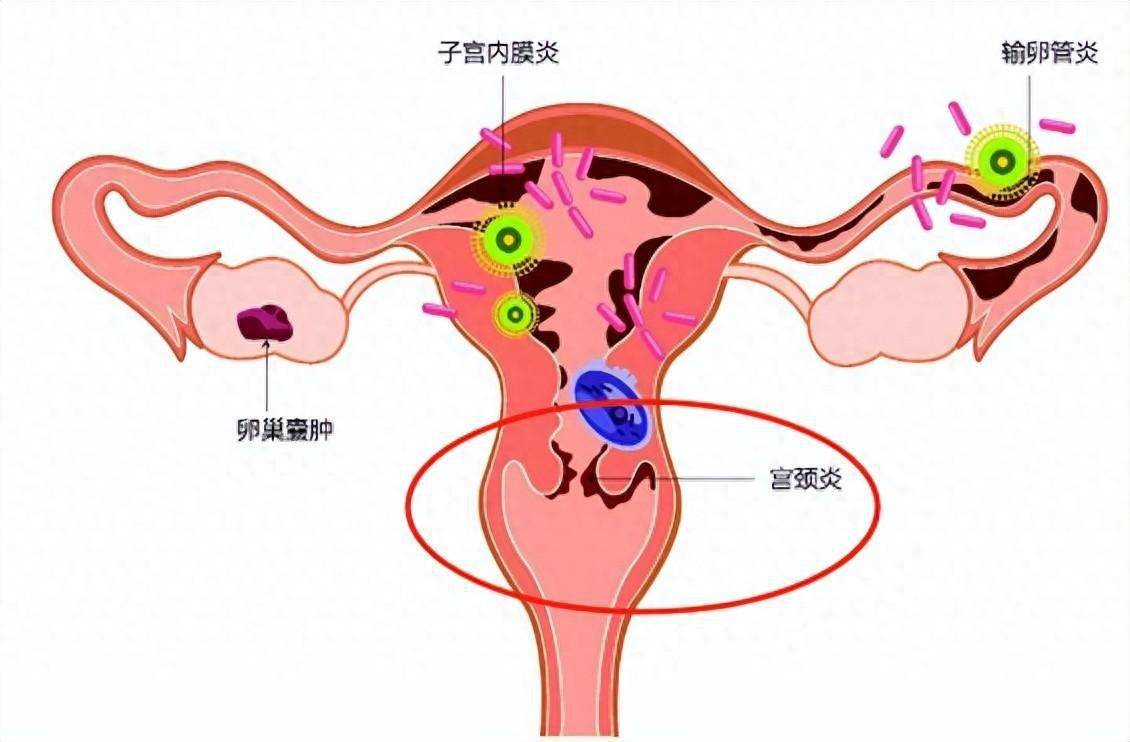 宫颈口变大图片