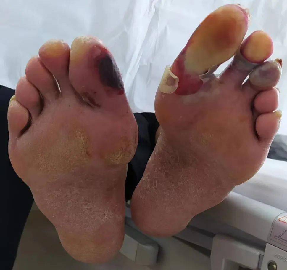 糖尿病科普系列之糖尿病足