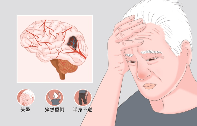 ，引起的病症就是脑卒中，俗称中风，包括缺血性脑卒中和出血性脑卒中。