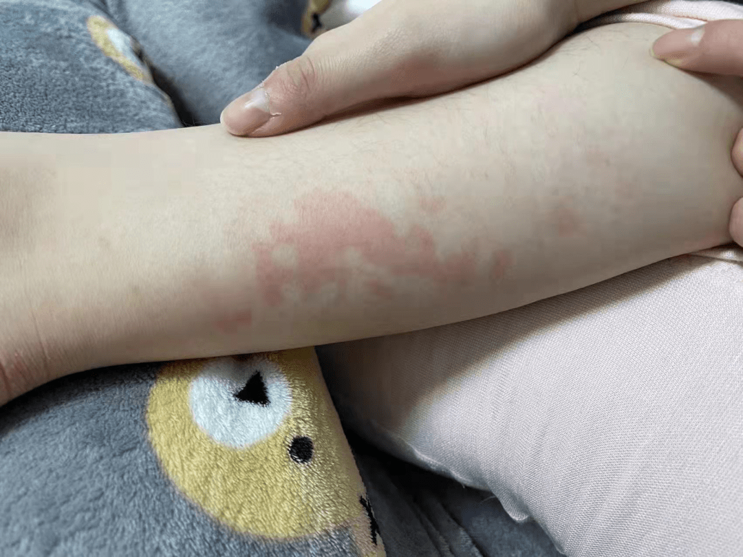 这款过冬神器可能导致低温烫伤_热水袋_刘女士_医生