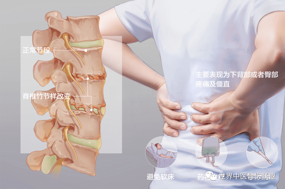 主要侵犯骶髂關節,脊柱骨突及外周關節,終導致脊柱畸形,發生脊柱